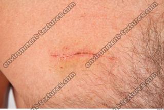 human skin scars 0003